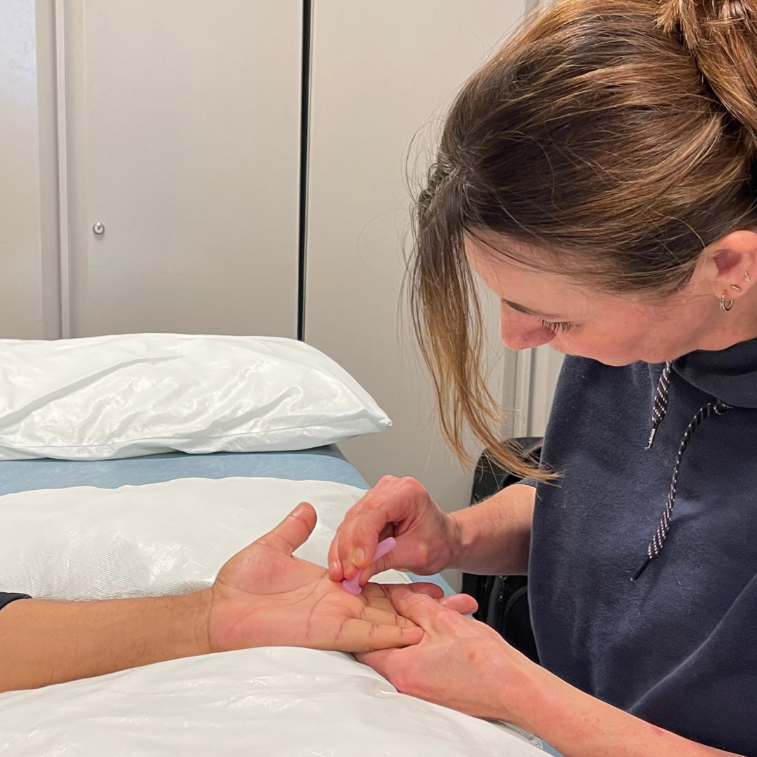 silicon cupping being applied by a scar therapist on a hand surgery scar